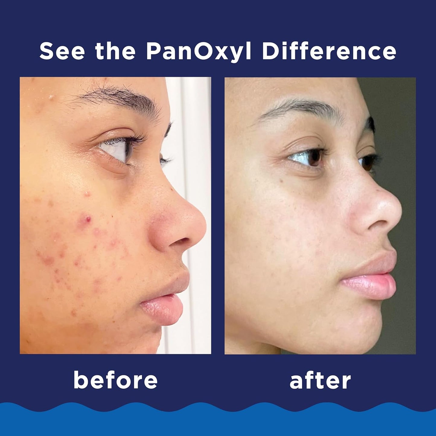 PanOxyl Acne Creamy Wash Peroxyde de Benzoyle 10%