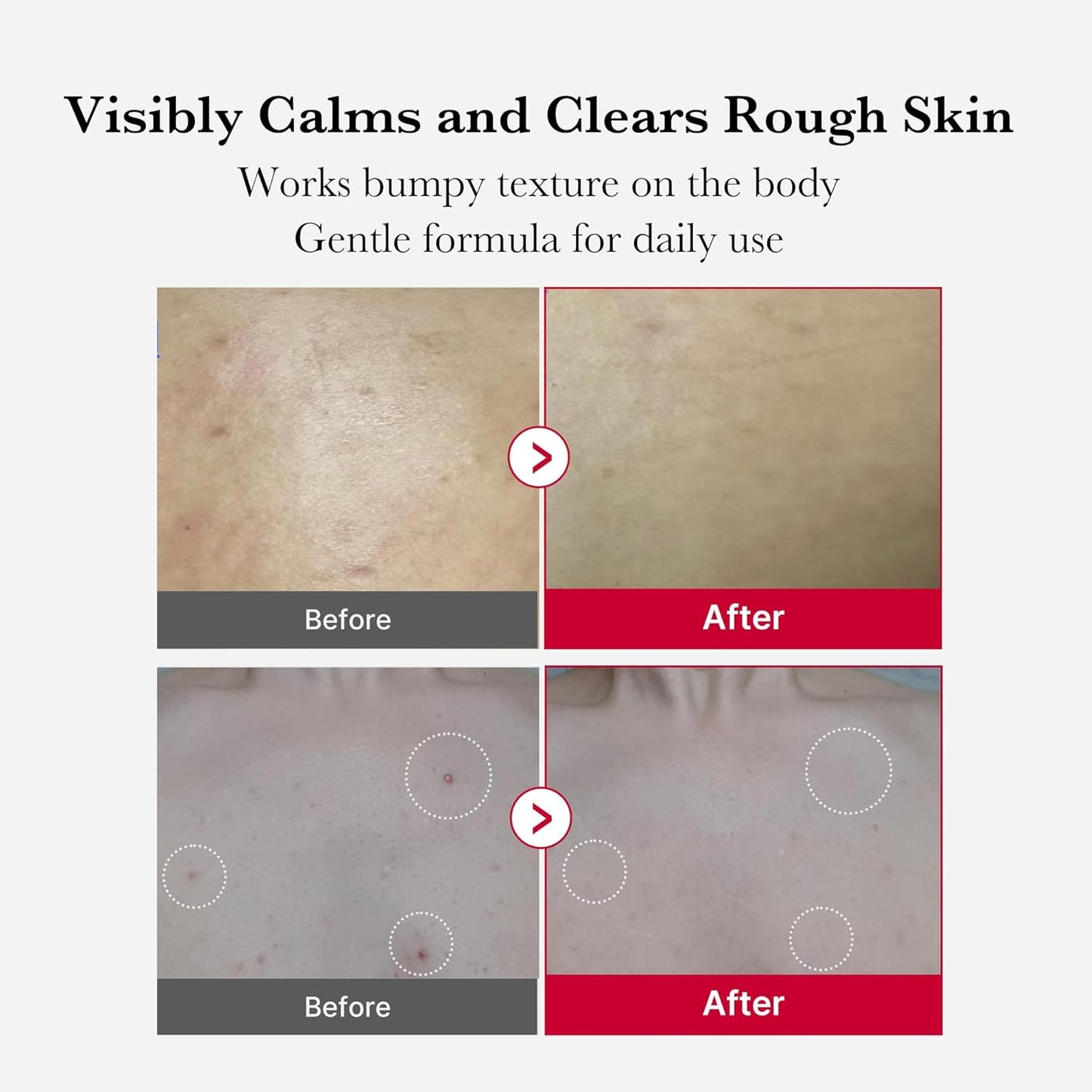 medicube - Red Acne Body Peeling Shot