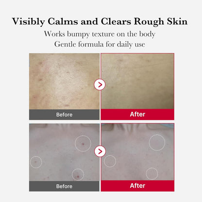 medicube - Red Acne Body Peeling Shot